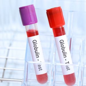 Lytinius hormonus sujungiantis globulinas – kodėl jis svarbus jūsų sveikatai?