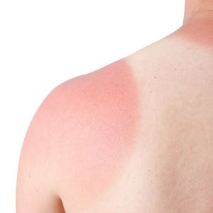 Kodėl nudegus saulėje nereikėtų teptis grietine ar kitais maisto produktais?