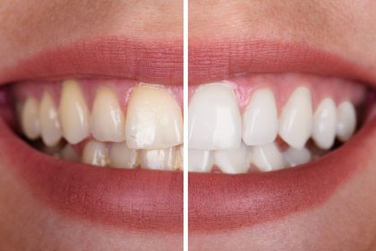 Odontologai atskleidė tikrą natūralių dantų balinimo priemonių poveikį dantims.