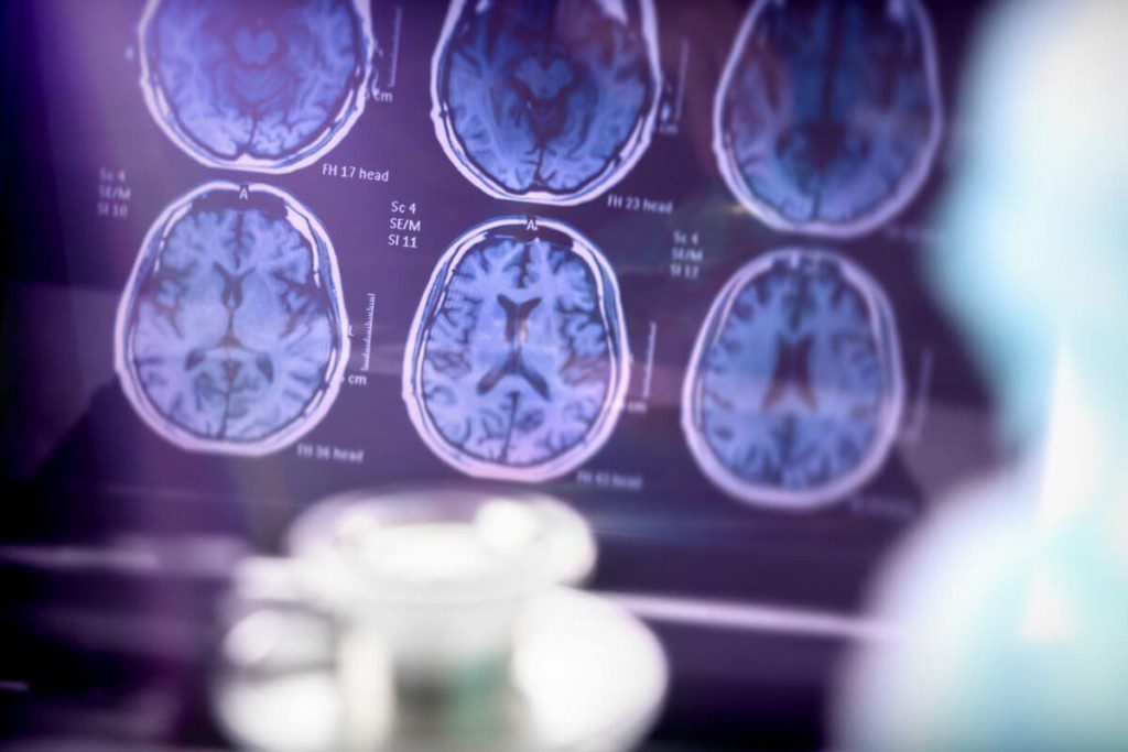 Alzheimerio ligos požymiai: uoslės praradimas