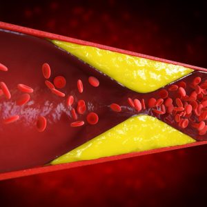 Arterijų valymas įtraukiant maisto produktus į racioną