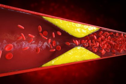 Arterijų valymas įtraukiant maisto produktus į racioną