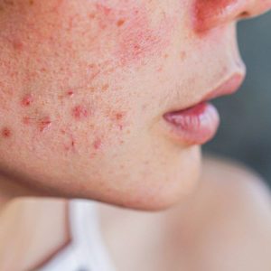 Kaip atskirti hormoninę ir bakterinę aknę