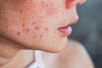 Kaip atskirti hormoninę ir bakterinę aknę