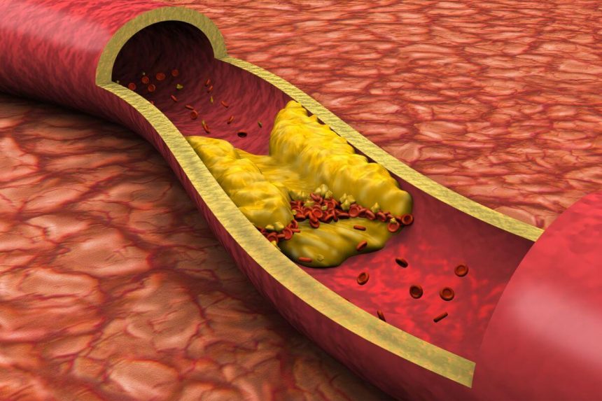 Ko negalima valgyti, kai yra aukštas cholesterolio lygis?