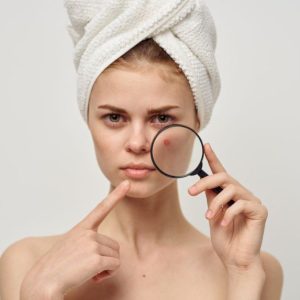 Veido aknė: dermatologė įvardijo pagrindines priežastis