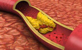 10 ženklų, kad jūsų arterijos kemšasi.