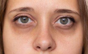 Kodėl po akimis atsiranda tamsūs ratilai? Dermatologė įvardijo galimas priežastis