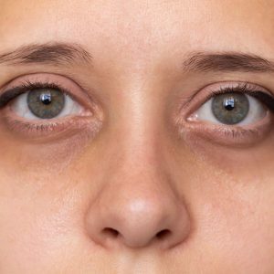 Kodėl po akimis atsiranda tamsūs ratilai? Dermatologė įvardijo galimas priežastis