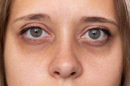 Kodėl po akimis atsiranda tamsūs ratilai? Dermatologė įvardijo galimas priežastis