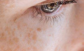 Veidas po vasaros pasipuošė pigmentinėmis dėmėmis? Štai, kas gali padėti