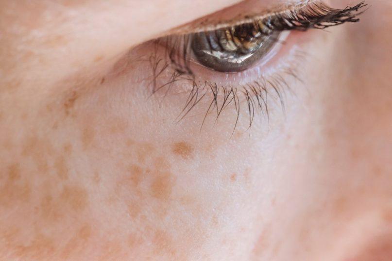 Veidas po vasaros pasipuošė pigmentinėmis dėmėmis? Štai, kas gali padėti