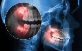 Ar būtina šalinti protinius dantis? Gydytojas paaiškina