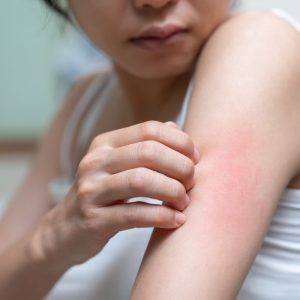 Kaip stresas gali pasireikšti ant odos: dilgėlinė ir jos gydymas
