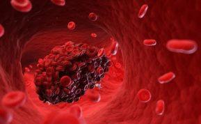 Kraujagyslių trombozė: priežastys, simptomai ir gydymas