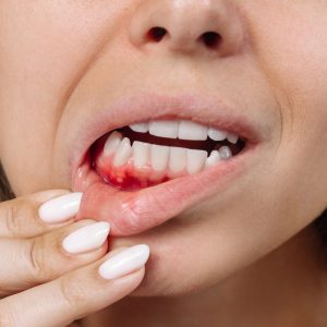 Periodontitas: kaip dantenų ligos veikia širdies ir kraujagyslių sveikatą