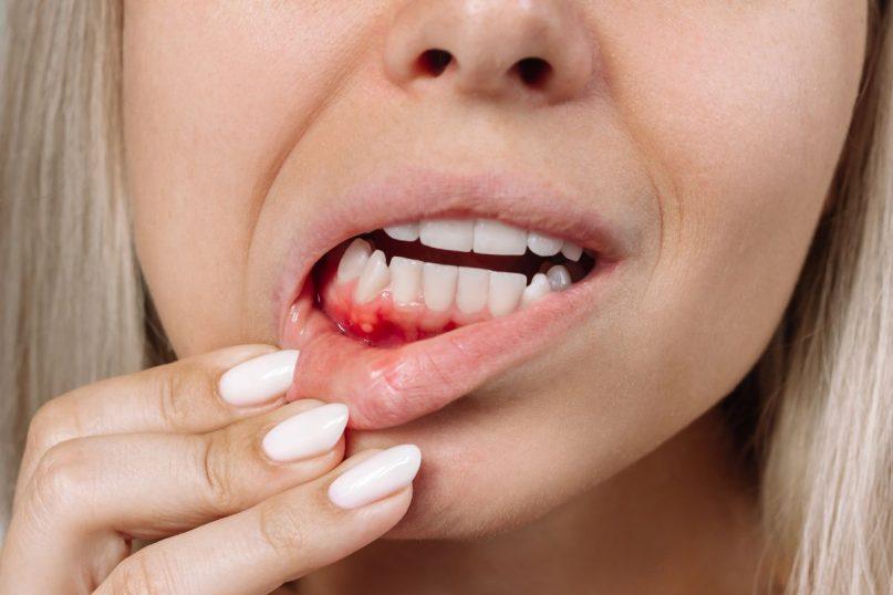 Periodontitas: kaip dantenų ligos veikia širdies ir kraujagyslių sveikatą