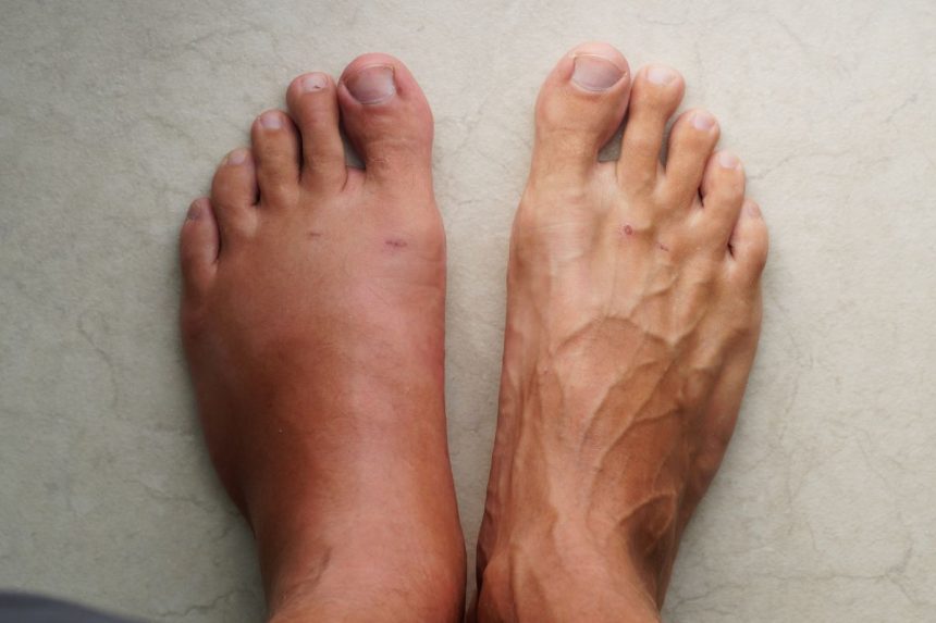 Kodėl moterų kojos ištinsta? Atskleidžiame galimas priežastis