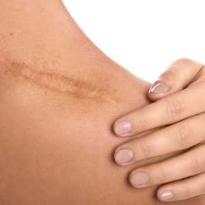 Naujas Vitamino D atradimas dermatologijoje. Gali pasitarnauti randų gydyme