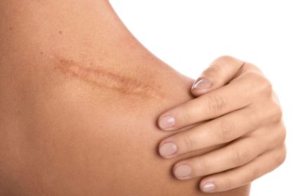 Naujas Vitamino D atradimas dermatologijoje. Gali pasitarnauti randų gydyme
