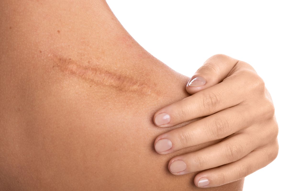 Naujas Vitamino D atradimas dermatologijoje. Gali pasitarnauti randų gydyme