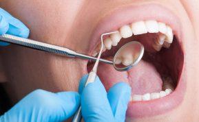 Ar jus kankina dantų akmenys ir tamsios dėmės ant jūsų dantų?