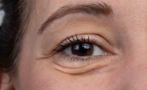 10 būdų, kurie tikrai padės atsikratyti maišelių po akimis