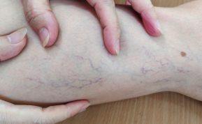 5 veiksmingos priemonės, kurios padės kovoti su venų varikoze!