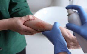 8 liaudies medicinos priemonės greitai pagalbai nudegus