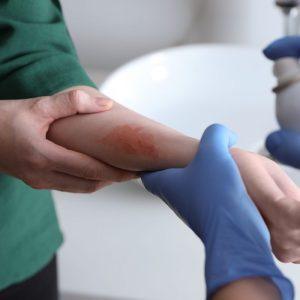 8 liaudies medicinos priemonės greitai pagalbai nudegus