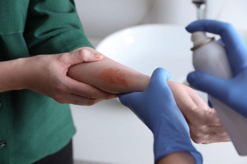 8 liaudies medicinos priemonės greitai pagalbai nudegus