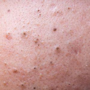 Jokių inkštirų ant veido! Sužinokite, kaip jų atsikratyti namų sąlygomis