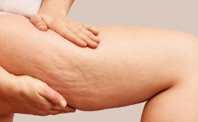 Ekspertai nurodė, kurie 5 maisto produktai gali sukelti celiulito problemas