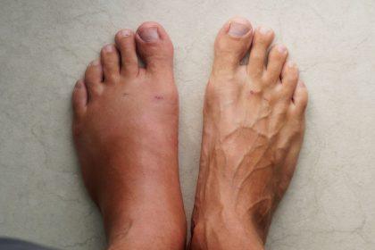 Ką daryti, jei keliaujant tinsta kojos?