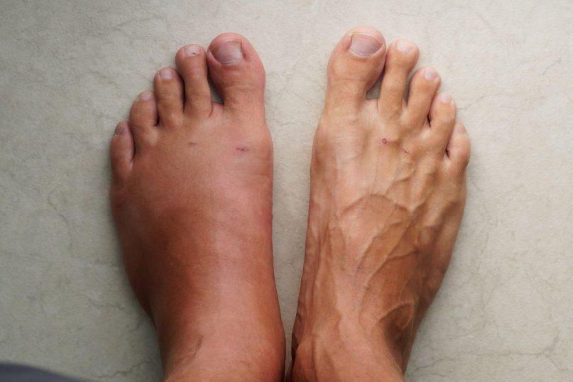 Ką daryti, jei keliaujant tinsta kojos?