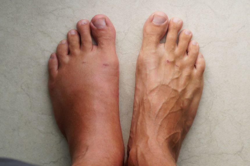 Ką daryti, jei keliaujant tinsta kojos?