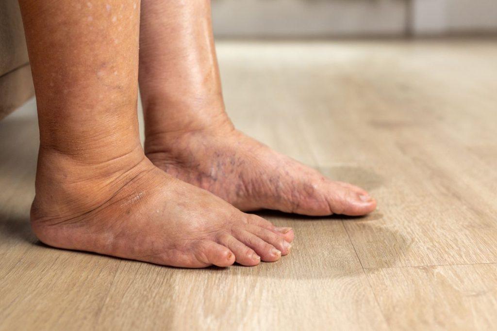 Menopauzės simptomai ir temperatūros pokyčiai