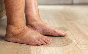 Ką valgyti, jei norite atsikratyti edemos?