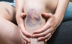 Kaip greičiau pašalinti mėlynę? Eksperto komentaras