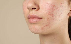 Kaip stresas veikia odą ir sukelia spuogus