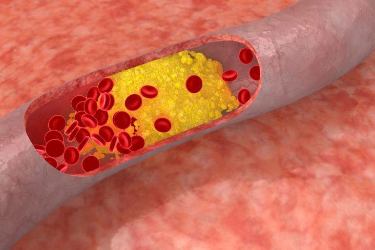 Kokių tipų cholesterolį turėtume žinoti?