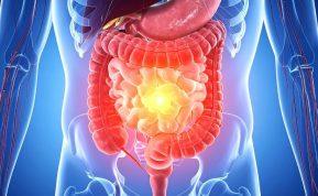 Mitybos specialistai pataria, kokie maisto produktai gali padėti pagerinti žarnyno veiklą