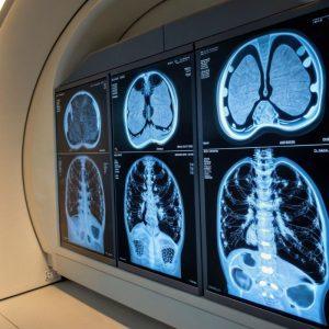 Tyrimas: „Ozempic“ ir „Wegovy“ gali iškraipyti vėžio tyrimų rezultatus – gydytojai perspėja dėl klaidingų diagnozių