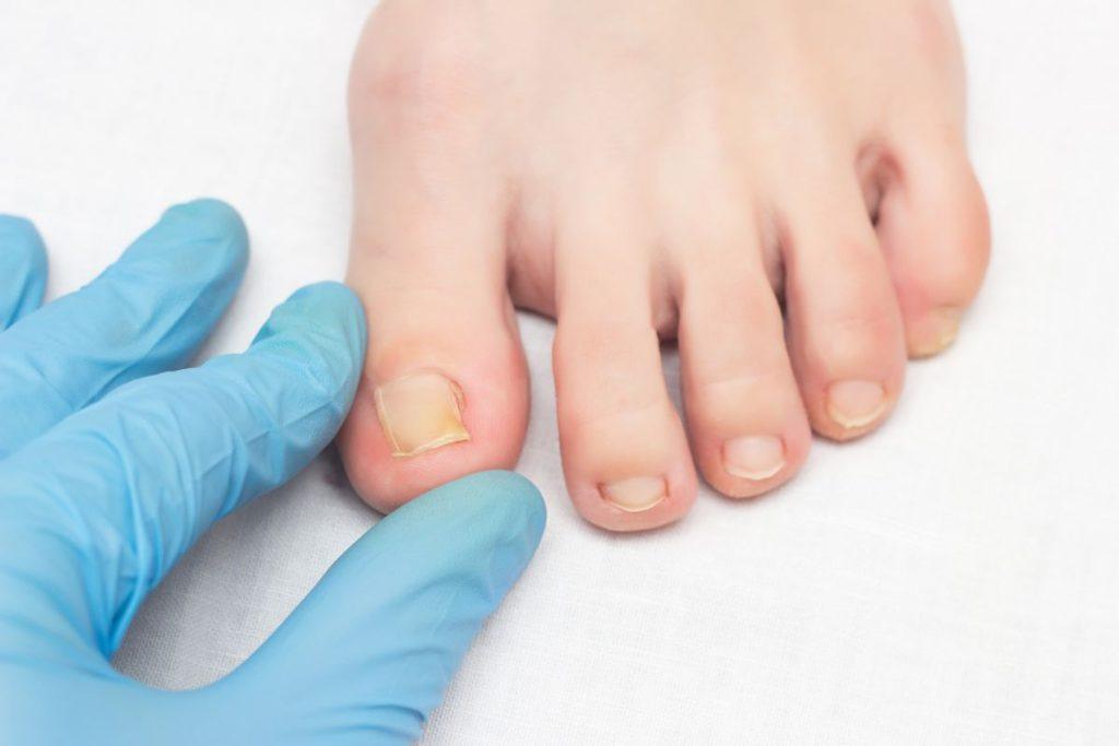 Stebuklingas arbatmedžio aliejus: 7 būdai, kaip jį panaudoti. Nagų grybelio gydymui