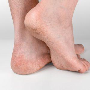 Priemonė, skirta atstatyti šiurkščius ir suskilinėjusius kulnus.