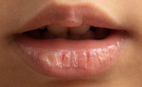 Suskeldėjusios lūpos? Keletas patarimų, kaip jas gydyti