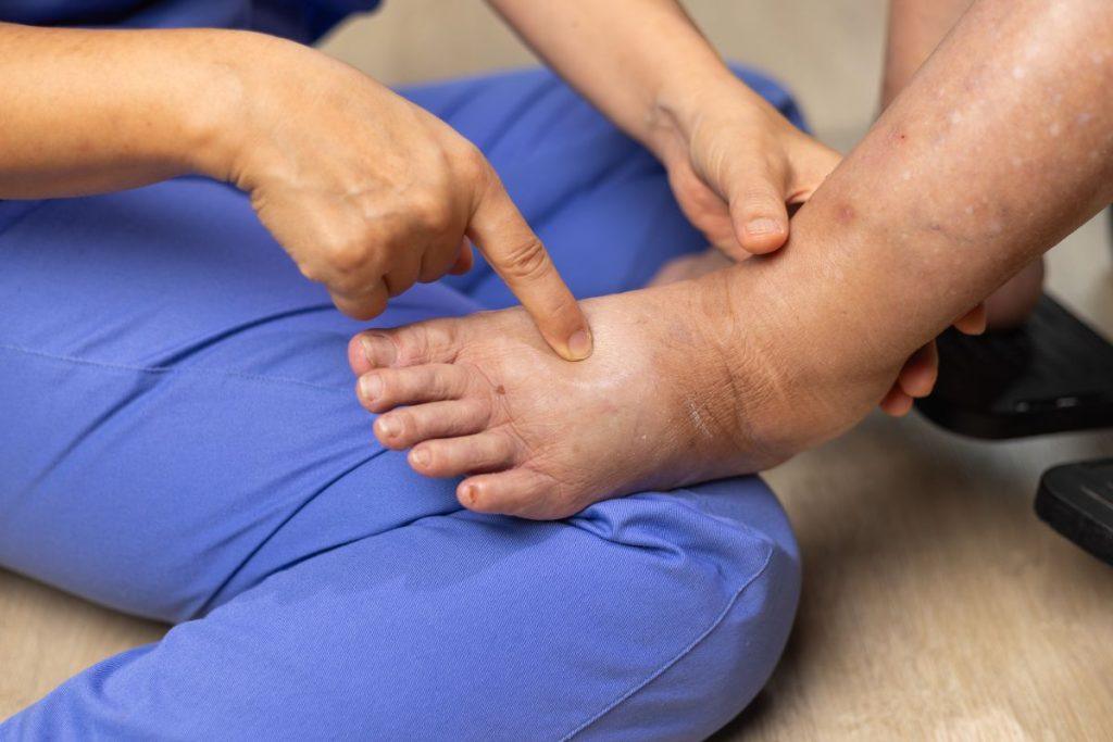 Sužinokite, kaip atsikratyti vandens pertekliaus iš organizmo. Kaip sužinoti, kad organizme prisikaupė skysčių