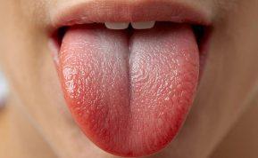 Visata perspėja apie pavojų: ką atskleidžia jūsų liežuvis?