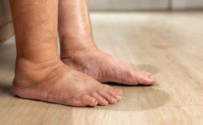 Apie kokias ligas gali įspėti edema?