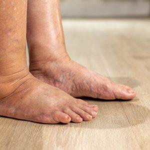 Apie kokias ligas gali įspėti edema?